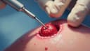 la biopsie — biopsy
