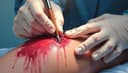 la suture — suture/stitches