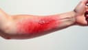 infection — инфекция